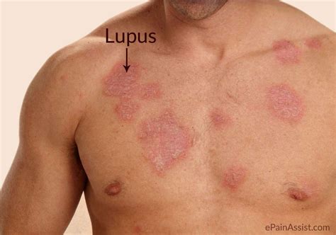 doença lupus